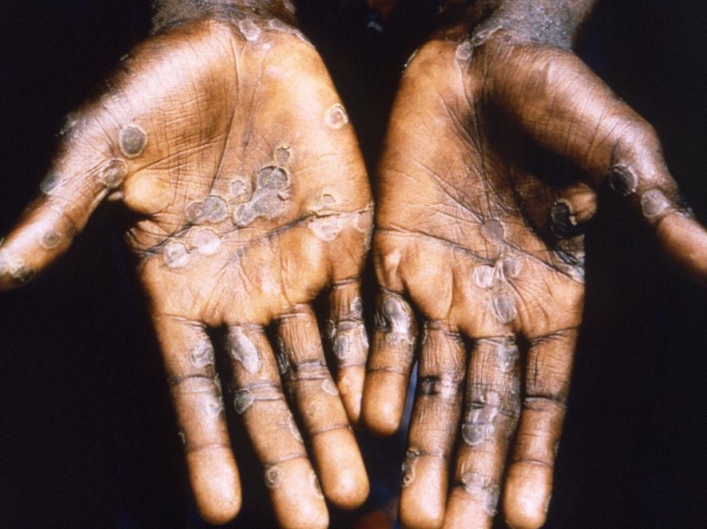 Mpox en Afrique : Une nouvelle souche de la variole du singe menace le continent